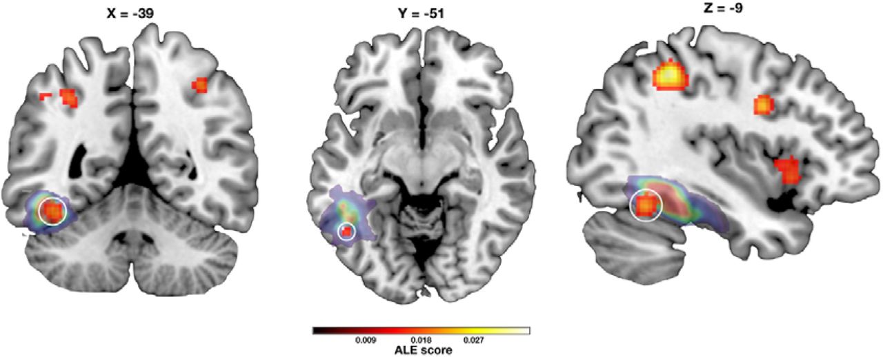 Brain location of the Fusiform Imagery Node